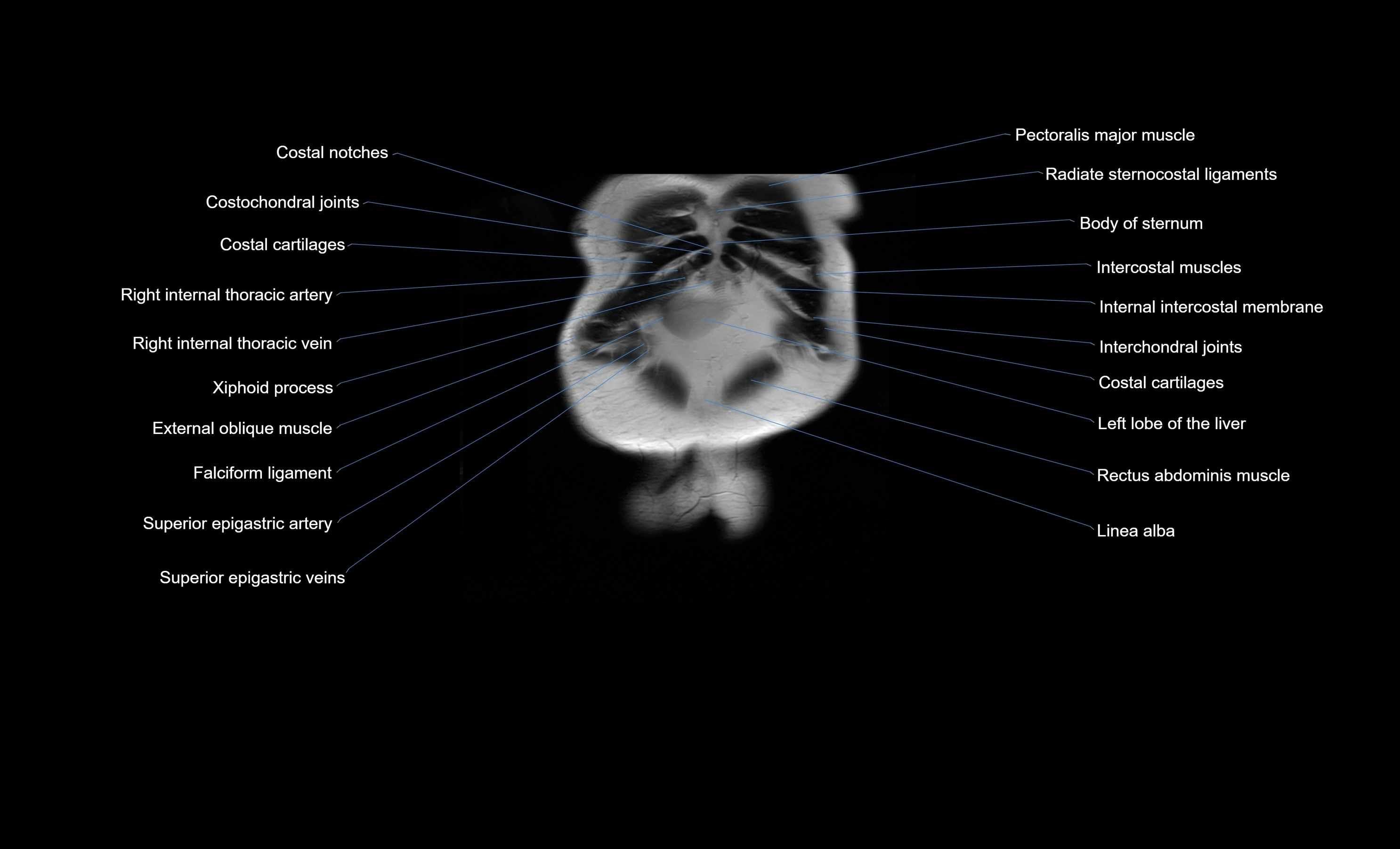 MRI Abdomen coronal labelled cross sectional anatomy radiology  image-img-00001-00006.webp